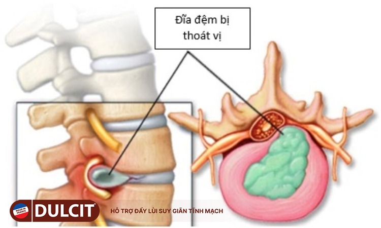 thoat-vi-dia-dem