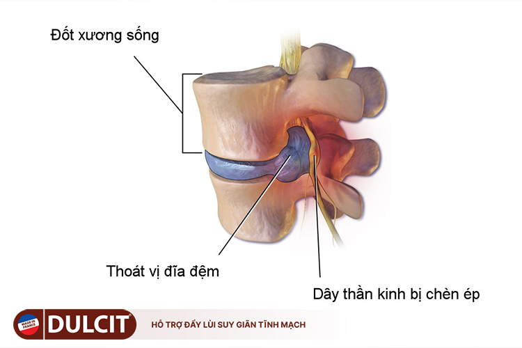 thoat-vi-dia-dem