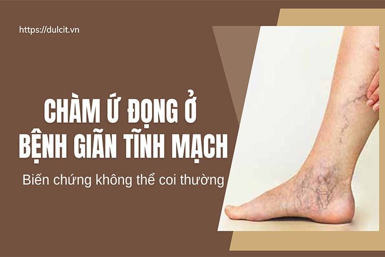 cham-u-dong-gian-tinh-mach