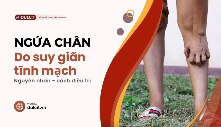 Giãn tĩnh mạch gây ngứa chân phải làm sao?