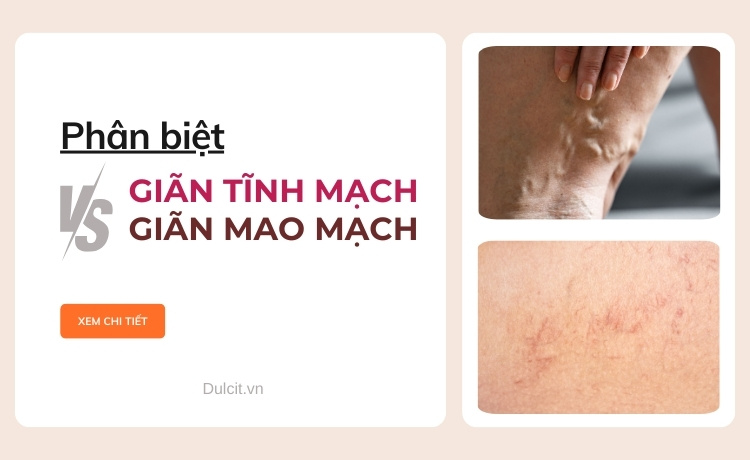 Phân biệt giãn tĩnh mạch và giãn mao mạch