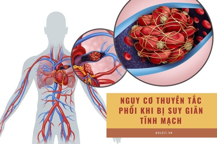 Suy giãn tĩnh mạch chân có thể gây biến chứng thuyên tắc phổi